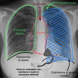 Tumore gli comprimeva cuore e polmone, salvato con complesso intervento alle Molinette